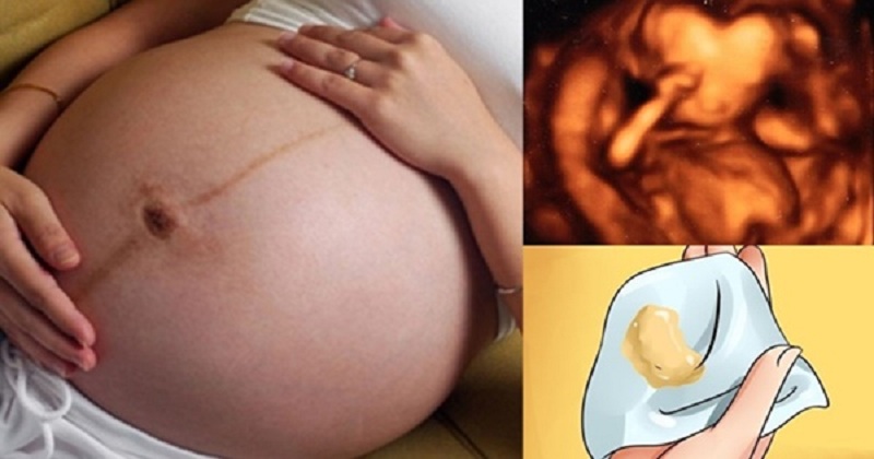 Mẹ bầu mắc viêm âm đạo cấp có nguy cơ sinh non rất cao