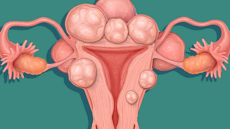 U xơ tử cung, ung thư cổ tử cung là biến chứng nguy hiểm của bệnh viêm âm đạo ra máu