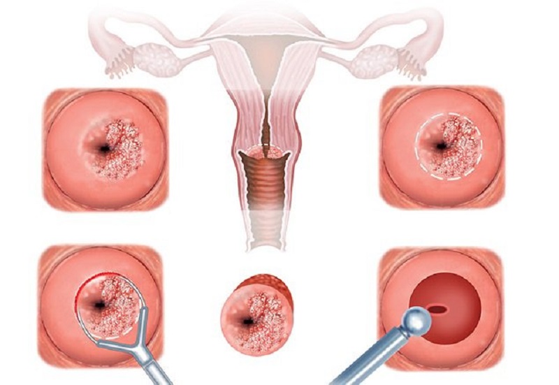Hình ảnh viêm cổ tử cung rõ nét nhất của người bệnh