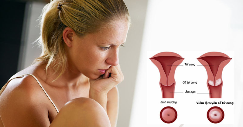 Viêm lộ tuyến tử cung là tình trạng tổn thương lành tính ở cổ tử cung